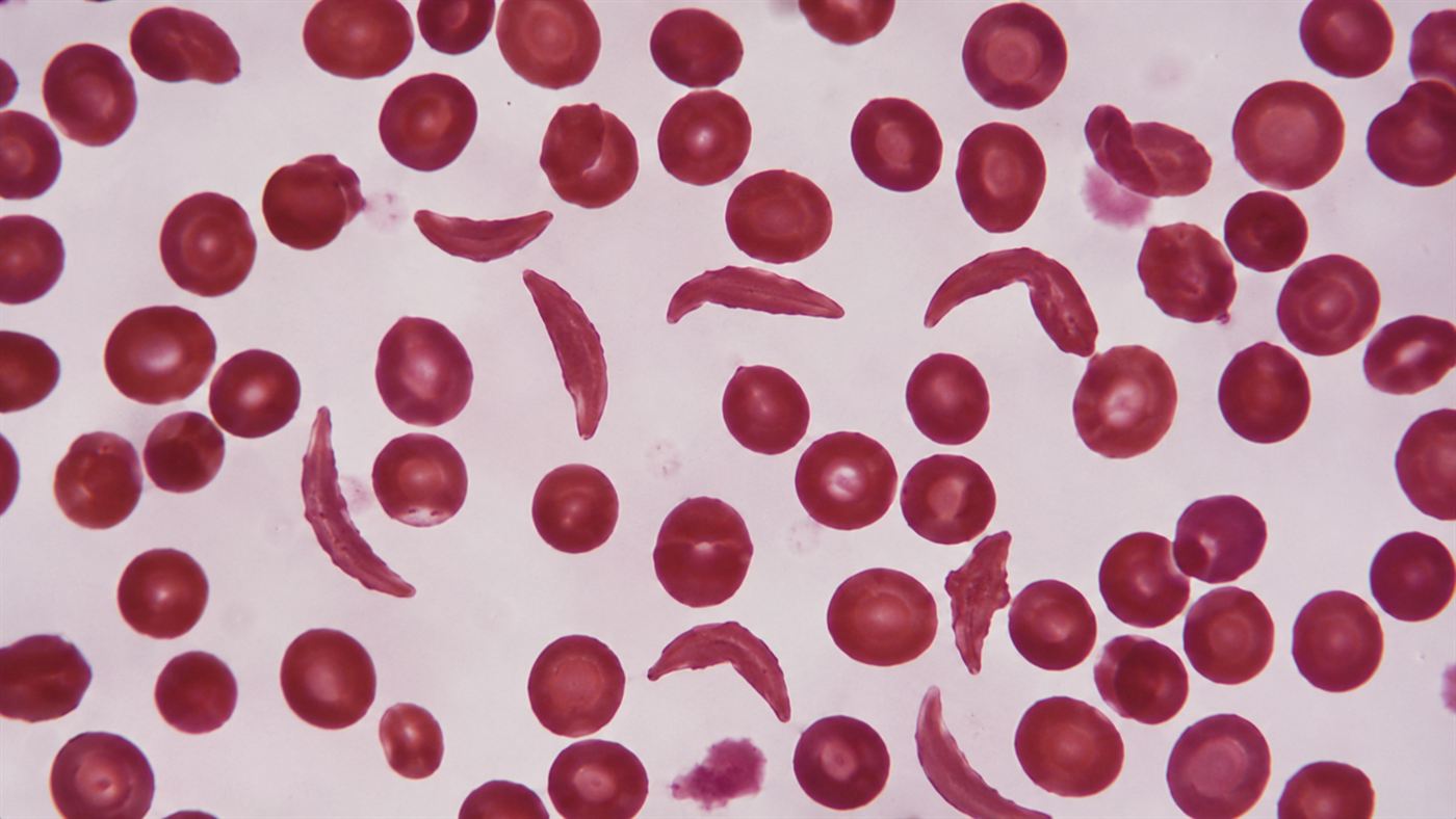 Microscope view of human red blood cells with several crescent, sickle-shaped cells among the round ones, sickle cell disease